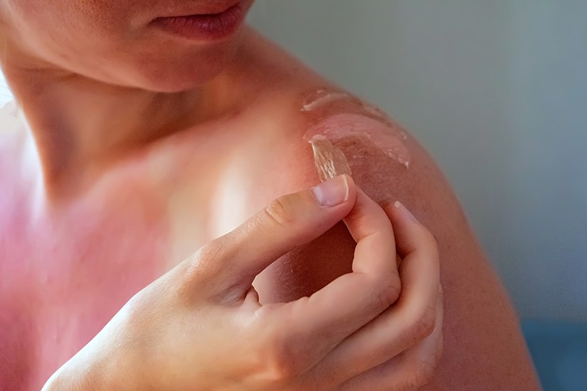 Cancerul de piele, tot mai frecvent. „Un risc major îl au persoanele care se expun frecvent la soare”