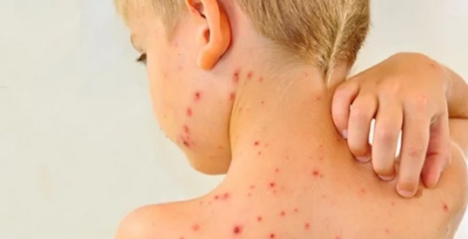 Rujeola rămâne la cote ridicate în țară. 646 de cazuri noi raportate în ultima săptămână