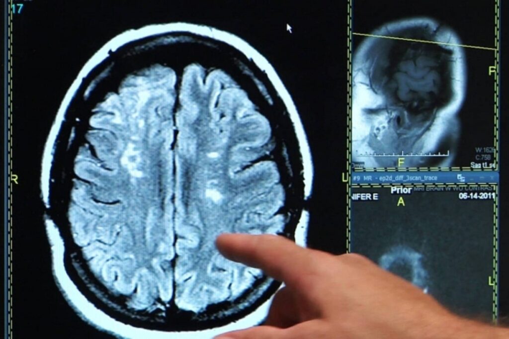 O procedură revolutionară care deblochează circulația cerebrală va fi folosită la un spital din Moldova: „Cresc șansele de recuperare completă”