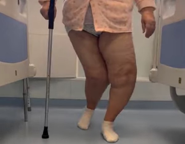 O femeie cu deformări grave la ambii genunchi, tratată cu succes într-un spital din România
