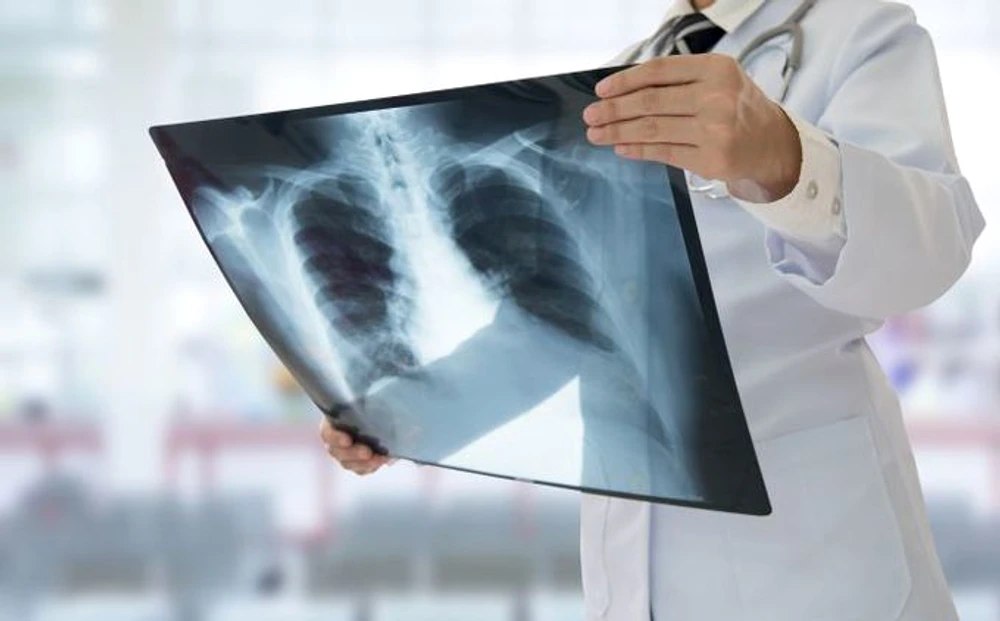 Simptomele ignorate ale cancerului de plămâni, boala de care suferă Ion Iliescu. „Nu are receptori de durere”