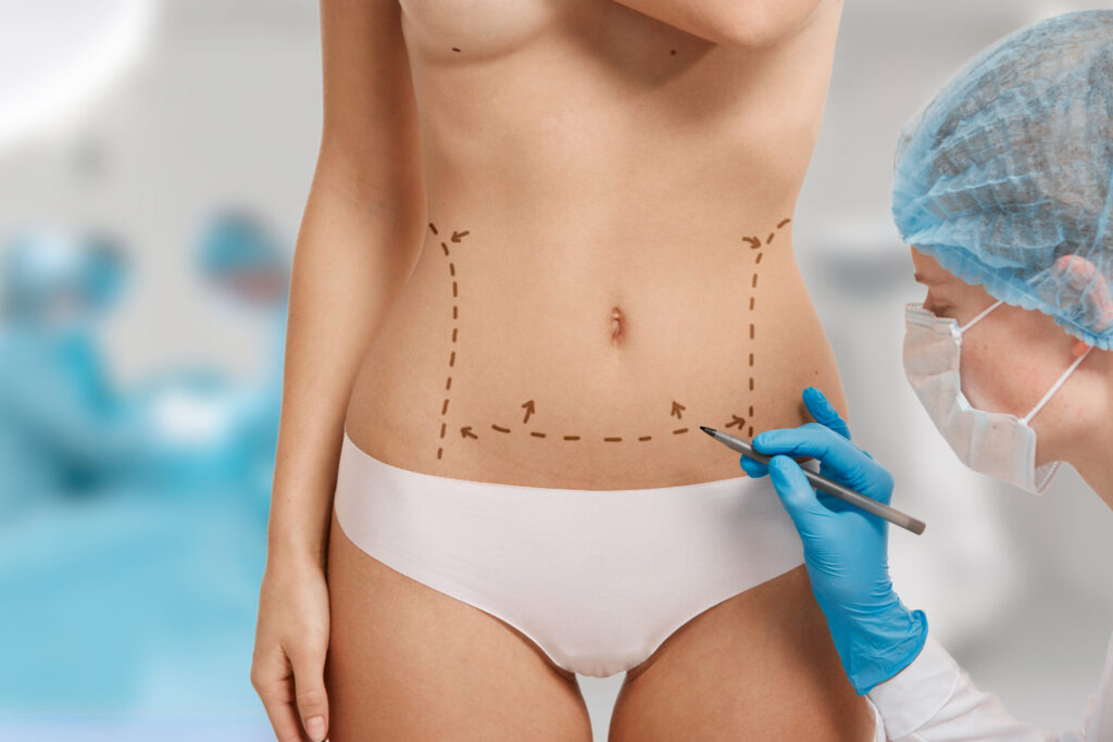 Corpul tau, regulile tale: Ghidul tau despre liposuctie si abdominoplastie